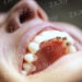 Lingual Ortodonti