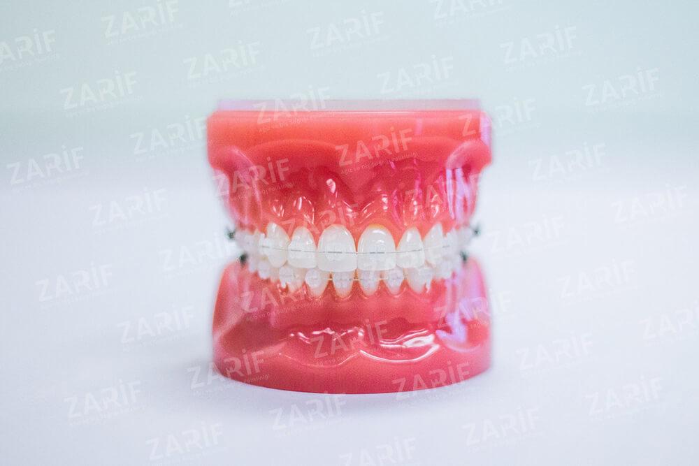 Porselen Diş Teli Tedavisi Fiyatları