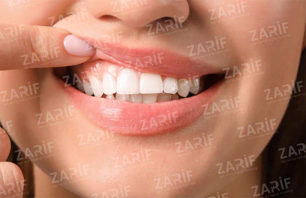 Diş Eti Tedavisi Temizliği – Tartar Tedavisi Fiyatları